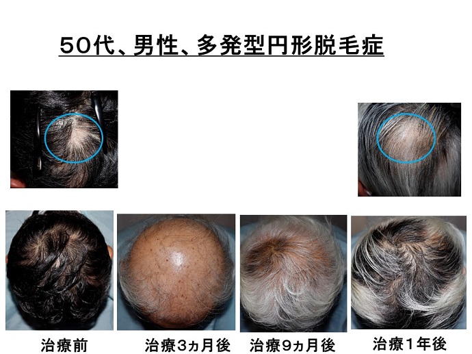 円形脱毛症　病院